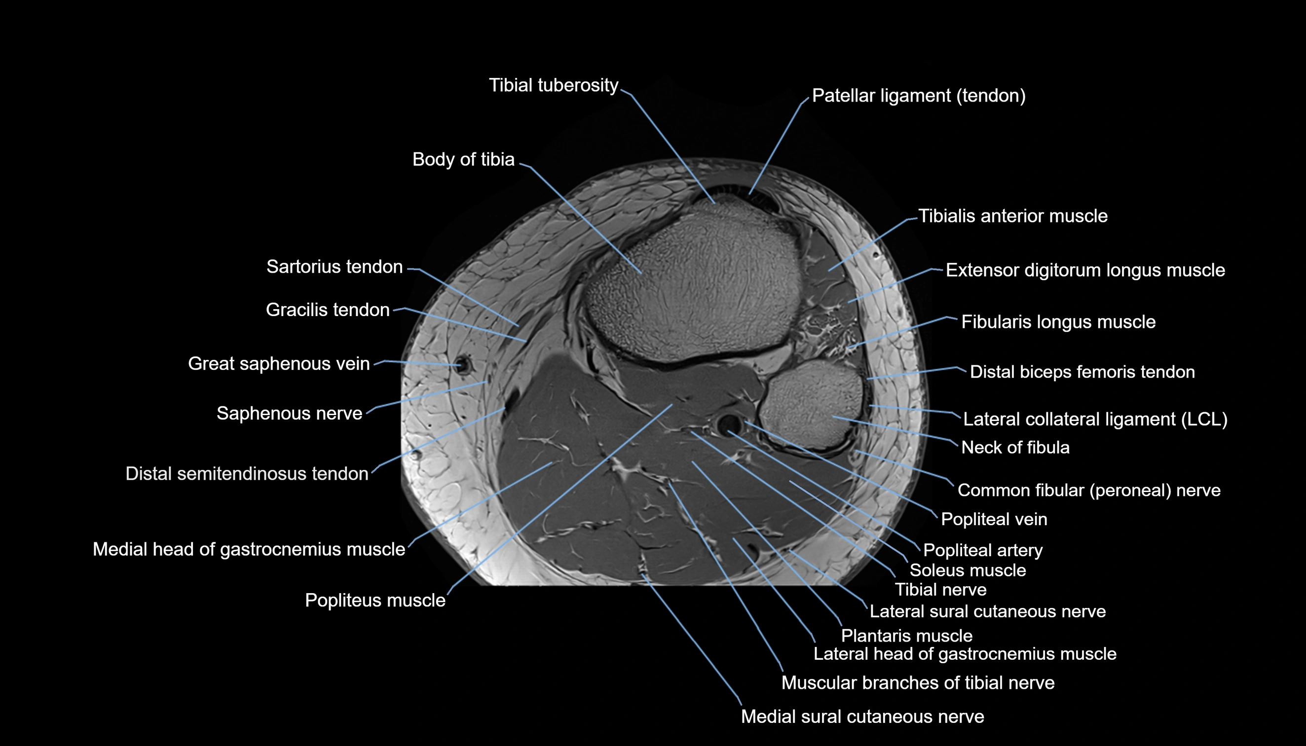 MRI knee  axial cross sectional anatomy 3T radiology  image-img-00001-00044.webp